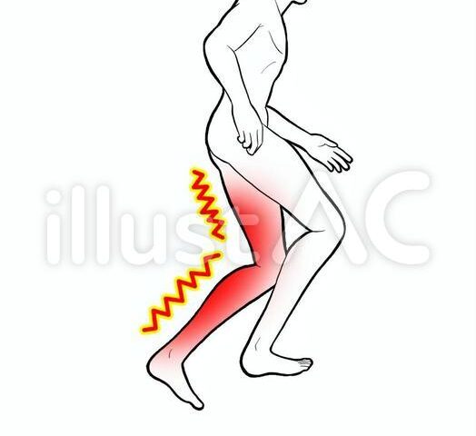 坐骨神経痛　宇治市大久保・城陽市　宇治東洋鍼灸整骨院